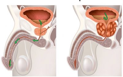 Rabotage de la prostate, opérer l&rsquo;adénome de la prostate en ambulatoire
