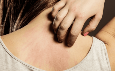 Peau atopique : comment en prendre soin ?