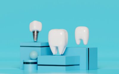 Implants dentaires : une solution durable pour retrouver sourire et confort